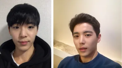 目つき矯正と切開、鼻の手術をしました。