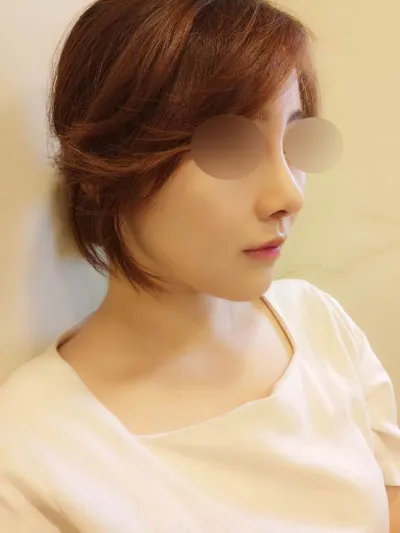 鼻筋、鼻先、顎プロテーゼ、ビーナスレーザー