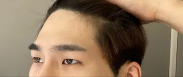 目つき矯正と額リフトを受けて5ヶ月後のレビューです！