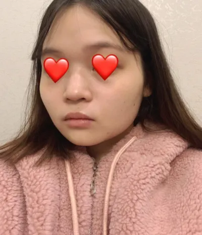 輪郭矯正+鼻整形から3ヶ月以上経ちました！