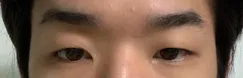 二重まぶた（部分切開）、目つき矯正、目頭切開