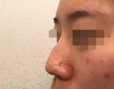 手術を受けて4ヶ月後のレビューです!! ᄒᄒᄒ