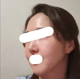 フェイスリフト再手術を受けて昔の写真を見たら満足^^