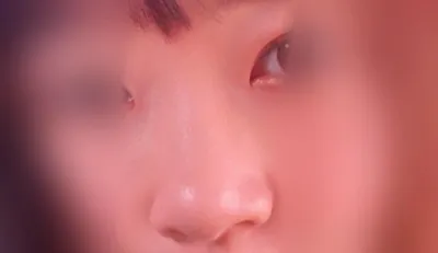 ジェイジュン整形外科で鼻フィラーを受けました:)