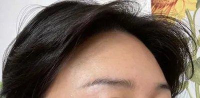 額脂肪移植