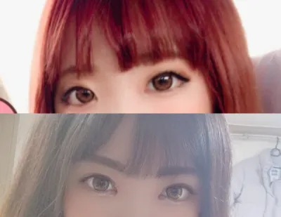 二重まぶた（埋没法）、目頭切開