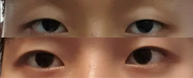 #切らない眼瞼下垂手術