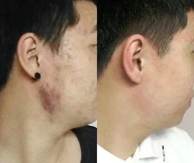 ニキビ治療6ヶ月後のレビュー