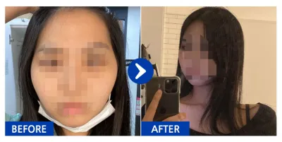 [バビトーク] 輪郭整形 / 1ヶ月目 / ニックネーム：ダラムィ