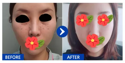 [バビトーク] 輪郭整形、目の下の脂肪再配置 / 2ヶ月目 / ニックネーム：ヤムヤムヤムヤム123