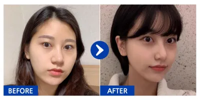 [バビトーク] 輪郭整形、脂肪移植 / 6ヶ月目 / ニックネーム：アメリカルノ