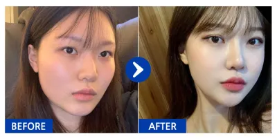 [バビトク] 輪郭整形、二重整形、鼻整形 / 7ヶ月目 / ニックネーム：ソリュン2