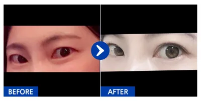 [バビトーク] 二重 / 3ヶ月目 / ニックネーム：ハナサマ