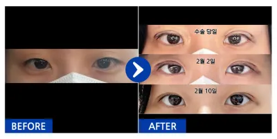 [カンナムオンニ] 自然癒着 / 1ヶ月目 / ニックネーム：ファルサビア