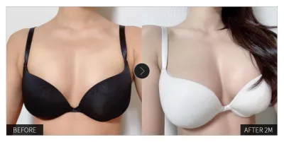 [カンナムオンニの口コミ] 豊胸手術 2ヶ月目 / ニックネーム：ウウウナア