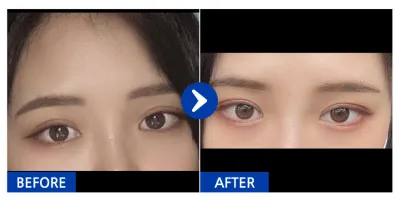 [カンナムオンニ] 自然癒着 / 1ヶ月目 / ニックネーム：ッティヨンㅇㅅㅇ