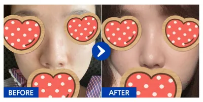 [カンナムオンニ] 鼻整形 / 1ヶ月目 / ニックネーム : yyjk3396