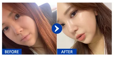 [バビトーク] 鼻整形 / 6ヶ月目 / ニックネーム：パンチャッカア