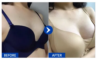 [バビトーク] 豊胸整形 / 5ヶ月目 / ニックネーム：ジョンシュギ