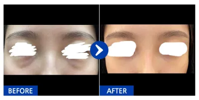 [バビトーク] 目の下の脂肪再配置 / 1ヶ月目 / ニックネーム：シュシュシュシュッ