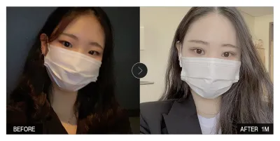 [カンナムオンニ レビュー] 目の整形 1ヶ月目 / ニックネーム：ネヌニニヌン