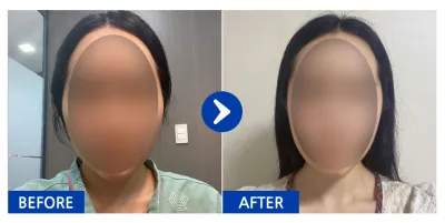 [バビトーク] 輪郭整形 / 1ヶ月目 / ニックネーム：ユムデディン