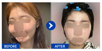 [バビトーク] 輪郭整形 / 1ヶ月目 / ニックネーム：イイウルルル