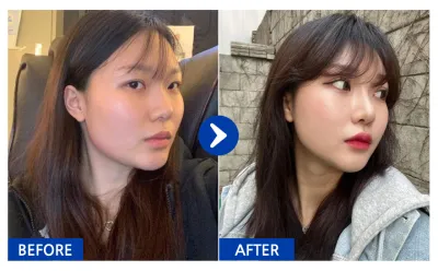 [バビトーク] 鼻整形 / 10ヶ月目 / ニックネーム：ソリュン2