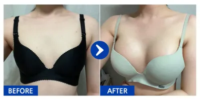 [バビトーク] 豊胸整形 / 1ヶ月目 / ニックネーム：二十四