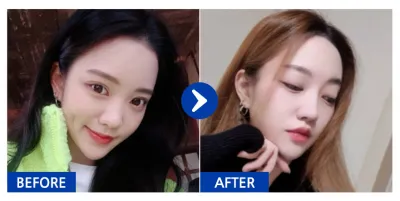 [カンナムオンニ] 鼻整形 / 6ヶ月目 / ニックネーム：グンティン