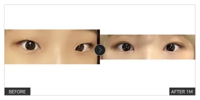 [カンナムオンニ 口コミ] 目の整形 1ヶ月目 / ニックネーム：meyh_