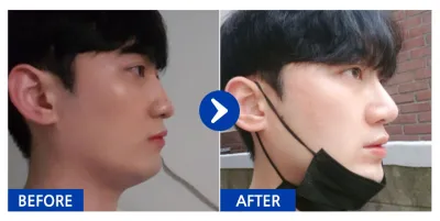 [カンナムオンニ] 鼻整形 / 6ヶ月目 / ニックネーム：ヘッギュ