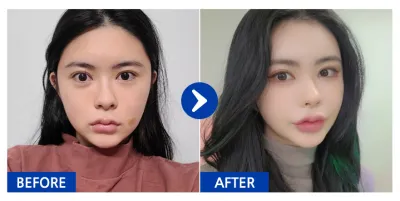 [カンナムオンニ] 脂肪移植 / 5ヶ月目 / ニックネーム : ooaa.a