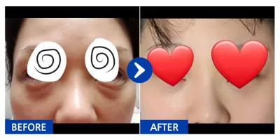 [カンナムオンニ] 目の下の脂肪再配置 / 3ヶ月目 / ニックネーム:ニャオンホン