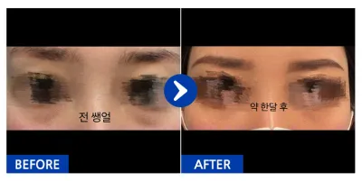 [カンナムオンニ] 目の下の脂肪再配置 / 1ヶ月目 / ニックネーム：ショロン