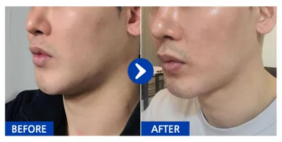 [バビトーク] 顔の脂肪吸引 / 2ヶ月目 / ニックネーム：クムブンオ