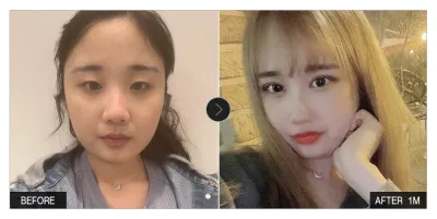 [バビトーク レビュー] 目の整形、輪郭整形 1ヶ月目 / ニックネーム：ジワリン