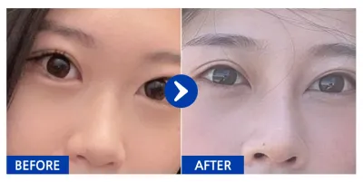 [カンナムオンニ] 鼻整形 / 2ヶ月目 / ニックネーム：オンチュ