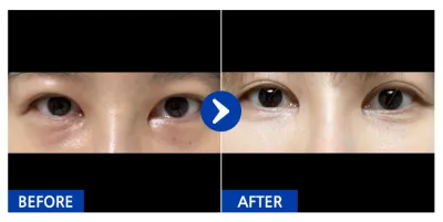 [カンナムオンニ] 目の下の脂肪再配置 / 1ヶ月目 / ニックネーム:anjjjjjjj