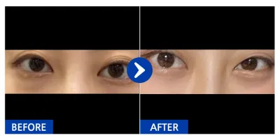 [カンナムオンニ] 目の下の脂肪再配置、下眼瞼 / 1ヶ月目 / ニックネーム：ナンドッギュ