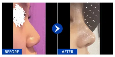 [カンナムオンニ] 鼻 / 1ヶ月目 / ニックネーム:kirakira.s