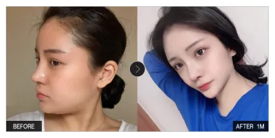 [カンナムオンニ レビュー] 顔の脂肪吸引 1ヶ月目 / ニックネーム：ソムサタンモグ