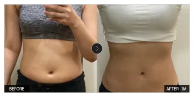 [カンナムオンニ 口コミ] 脂肪吸引 1ヶ月目 / ニックネーム：わたあめモグ