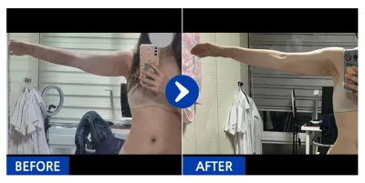 [バビトーク] 脂肪吸引 / 1ヶ月目 / ニックネーム：ミトゥィントッキ