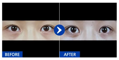 [バビトーク] デュアル切開、目の下の脂肪再配置 / 1ヶ月目 / ニックネーム：ニャアアアエエヨン