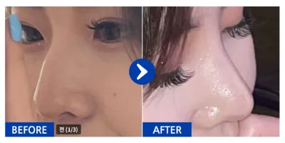 [カンナムオンニ] 鼻整形 / 1ヶ月目 / ニックネーム:skfk2299