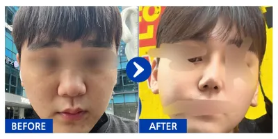 [カンナムオンニ] 鼻整形 / 2ヶ月目 / ニックネーム：鼻が悩みです