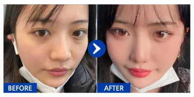 [カンナムオンニ] 目の下の脂肪再配置 / 6ヶ月目 / ニックネーム：将来の夢はカンナム美人