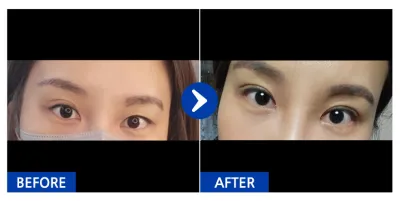 [カンナムオンニ] 自然癒着(二重) / 2週目 / ニックネーム：ダルボンイ