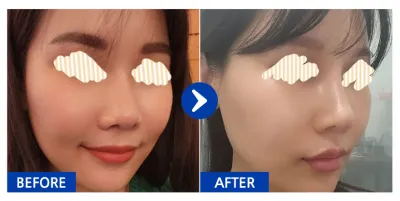 [バビトーク] 鼻再手術 / 1ヶ月目 / ニックネーム: wane